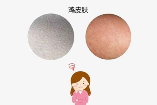 用什么去雞皮膚最有效 去雞皮膚不能“頂風作浪”