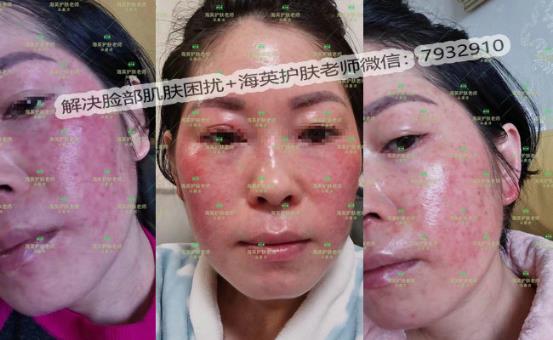 海英:激素臉是怎么形成的?激素臉怎么修復?激素臉的修復周期是多久?