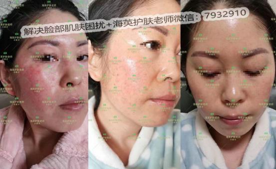 海英:激素臉是怎么形成的?激素臉怎么修復?激素臉的修復周期是多久?