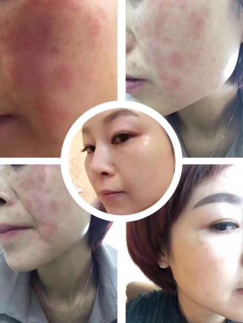 海英:激素臉是怎么形成的?激素臉怎么修復?激素臉的修復周期是多久?