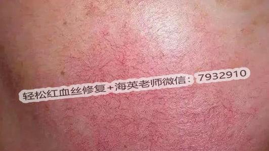 臉上有紅血絲怎么去除?改善紅血絲有什么好辦法嗎?