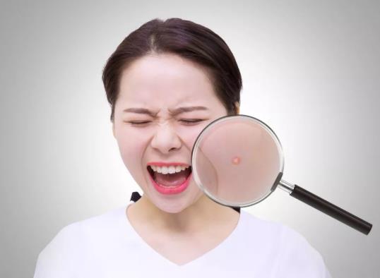 擠痘痘顱內感染會死嗎?擠痘痘顱內感染多久能看出來?