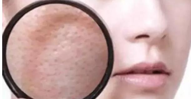 臉上毛孔粗大看起來皮膚就很不好 7大因素造成毛孔粗大