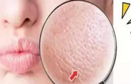 毛孔粗大用食鹽有用嗎 毛孔粗大敷什么面膜好