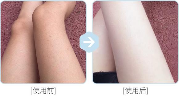 去雞皮膚最有效的藥膏 根源去除才更安心