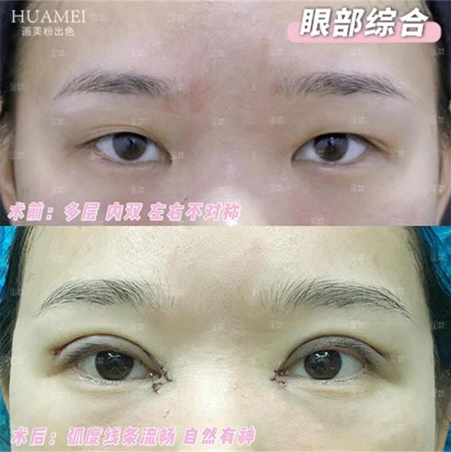 5S高難度眼修復@劉風卓