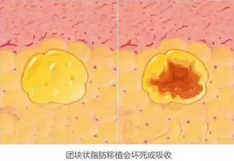煙臺曙光整形醫院怎么樣?做自體脂肪豐胸,到底能不能一次成型? 圖片1111.png