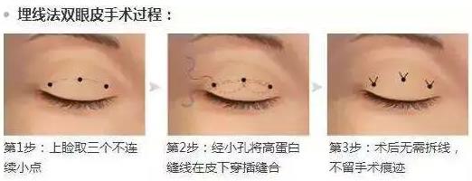 八大處楊欣教授:雙眼皮手術后需要多久才能恢復