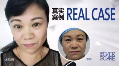 北京伊美爾楊紅巖醫生怎么樣?