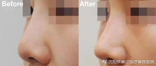 沈陽伊美爾劉紫薇鼻整形 專業醫師力量