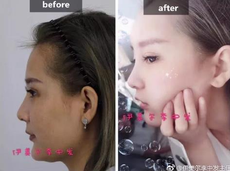 伊美爾愛康醫院自體脂肪填充效果好不好?