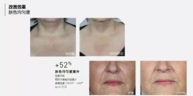 菲洛嘉價格貴不貴?北京伊美爾紫竹幫你恢復(fù)水潤美白