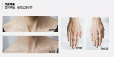 菲洛嘉價格貴不貴?北京伊美爾紫竹幫你恢復(fù)水潤美白