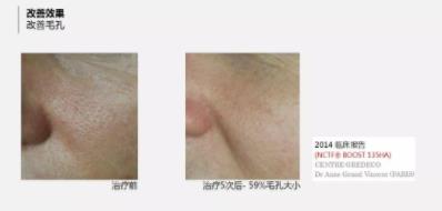 菲洛嘉價格貴不貴?北京伊美爾紫竹幫你恢復(fù)水潤美白