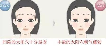 如何填充面頰凹陷?面頰部填充都有哪些填充材料