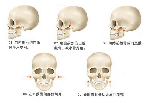 顴骨增高手術適合哪些人做?顴骨增高手術的注意事項