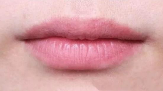 北京伊美爾醫療醫院:玻尿酸豐唇的效果