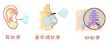 廣州韓妃整形攻略:隆鼻方法哪種好?