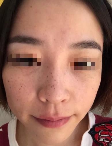 廈門薇格整形醫(yī)院皮秒激光如何 幫你解決各種肌膚問題
