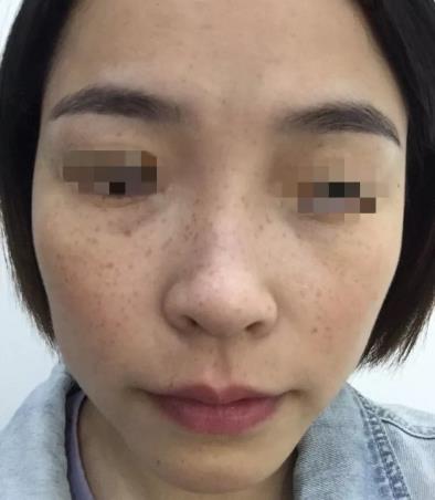 廈門薇格整形醫(yī)院皮秒激光如何 幫你解決各種肌膚問題