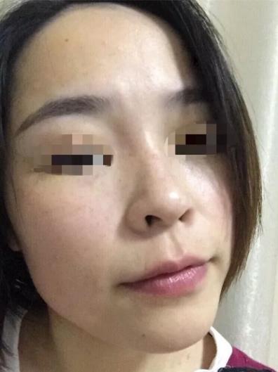 廈門薇格整形醫(yī)院皮秒激光如何 幫你解決各種肌膚問題