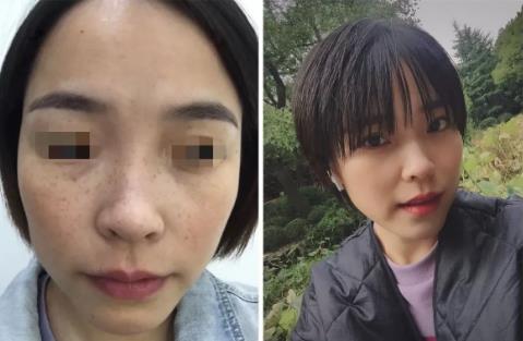 廈門薇格整形醫(yī)院皮秒激光如何 幫你解決各種肌膚問題