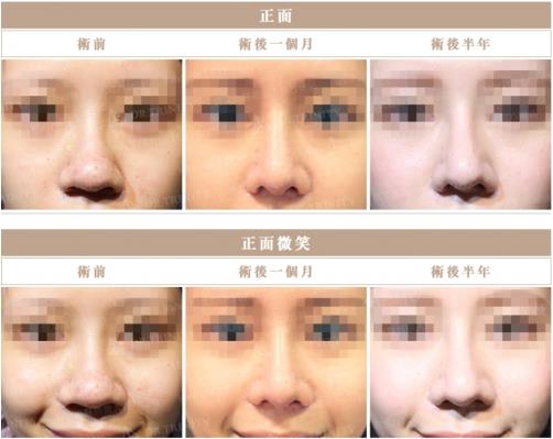 臺灣雅豐醫美產后隆鼻火熱 整型隆鼻回歸更添自信