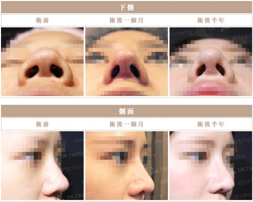 臺灣雅豐醫美產后隆鼻火熱 整型隆鼻回歸更添自信