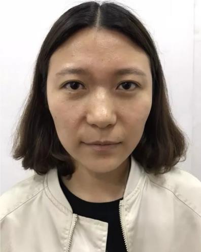 廈門薇格整形醫院:玻尿酸讓她從“干癟火柴妹”變成“精致小姐姐”