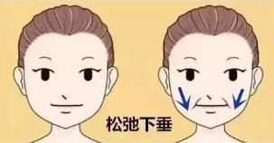 廈門薇格整形醫院艾莉薇技術:效果長達,12-18個月