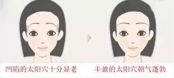 廈門薇格整形醫院艾莉薇技術:效果長達,12-18個月