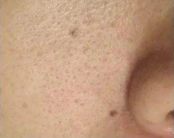 北京伊美爾愛康醫院: 點陣激光多久恢復
