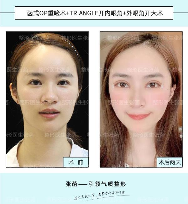 埋線雙眼皮、韓式三點及菡式OP重瞼術哪種方式更適合你吶?