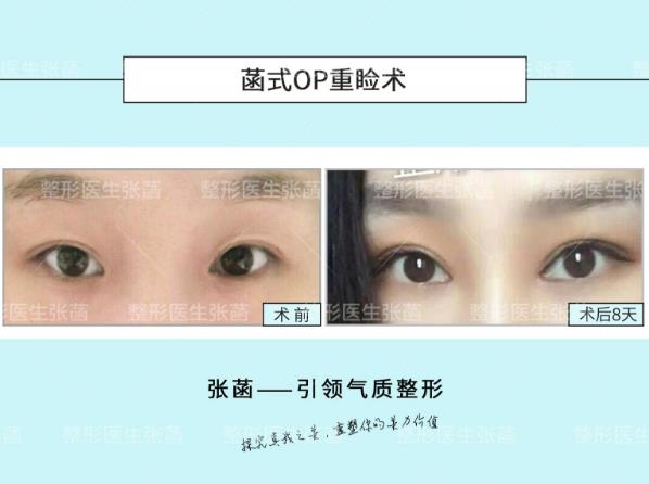 埋線雙眼皮、韓式三點及菡式OP重瞼術哪種方式更適合你吶?