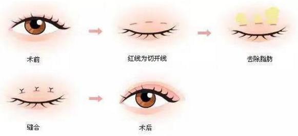 埋線雙眼皮、韓式三點及菡式OP重瞼術哪種方式更適合你吶?