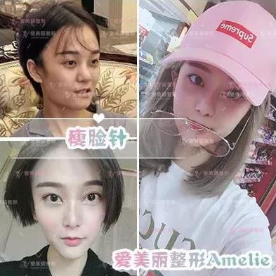 鄭州愛美麗醫院,有一種肉毒素,打了“它”,男友比原來更加愛你了!