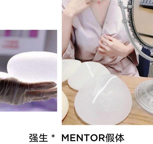 南京MEYA袁呂榮院長隆胸效果怎么樣 大牌名醫親診親治