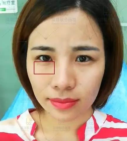 深圳聯合麗格:為什么明星一定要做熱瑪吉+線雕