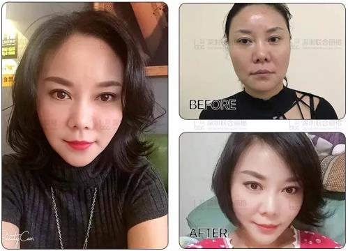 深圳聯合麗格:為什么明星一定要做熱瑪吉+線雕