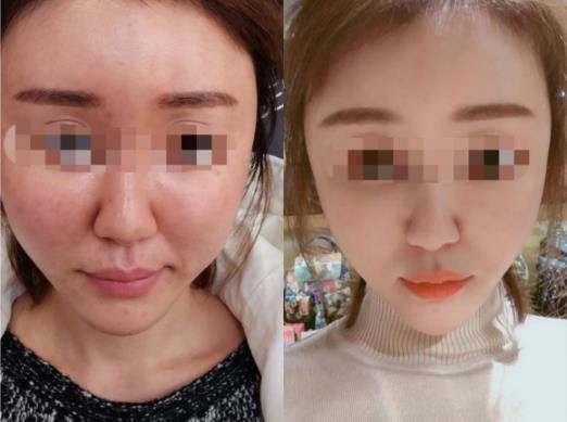 丁小邦博士:注射物生長因子取出使用什么方法好