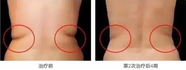武漢藝星整形醫院:6月22-28日酷塑減脂專場,讓你輕輕松松的減肥!