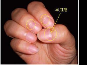 指甲上的半月痕你懂多少？指甲半月痕與健康吉兇