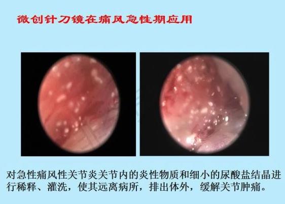 濟南中醫風濕病醫院中醫微創針刀鏡技術在痛風性關節炎中臨床應用
