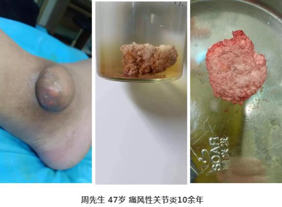 濟南中醫風濕病醫院中醫微創針刀鏡技術在痛風性關節炎中臨床應用