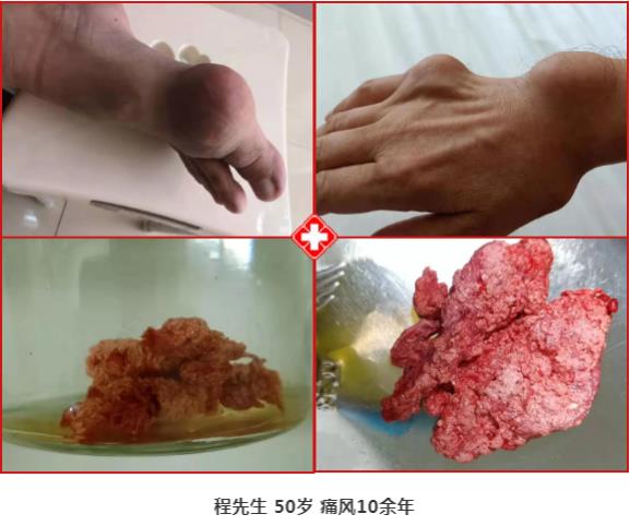 濟南中醫風濕病醫院中醫微創針刀鏡技術在痛風性關節炎中臨床應用