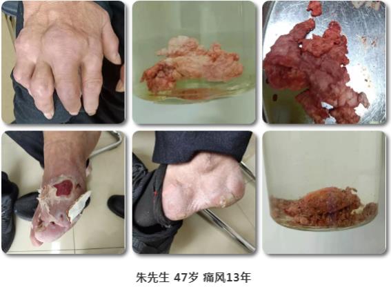濟南中醫風濕病醫院中醫微創針刀鏡技術在痛風性關節炎中臨床應用