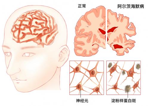 【杉寶解讀】NAD+及其前體——阿茲海默癥患者的福音