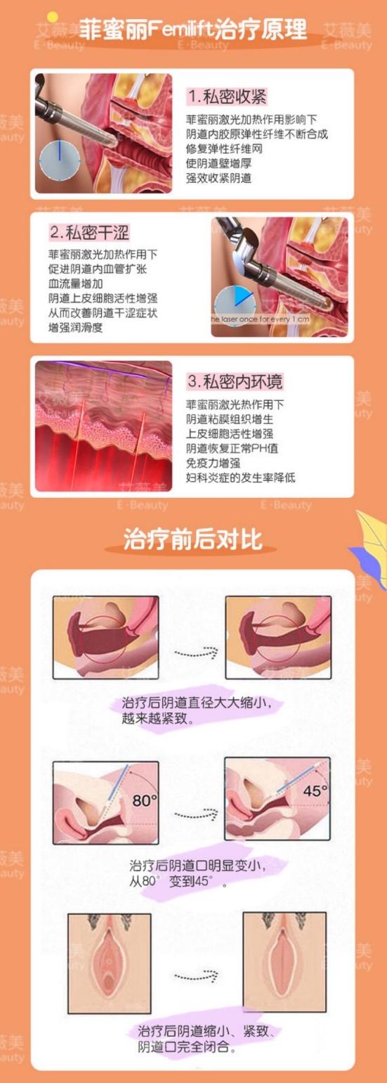 西安艾薇美女性整復 開展私密微整提升女性生活質量