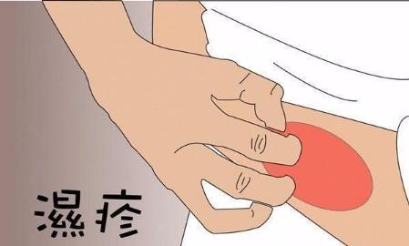 長濕疹不一定是壞事?人一旦得了濕疹就一輩子有嗎