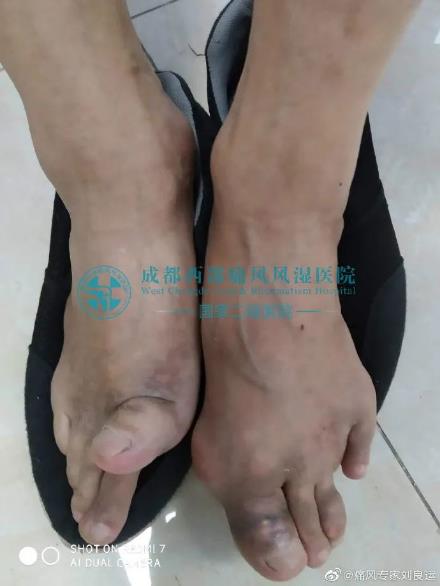 在成都西部痛風(fēng)風(fēng)濕醫(yī)院即可預(yù)約上海風(fēng)濕免疫科博導(dǎo)